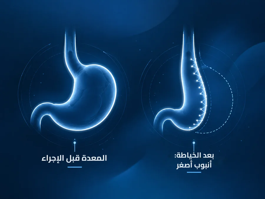 المعدة قبل الإجراء وبعد الخياطة